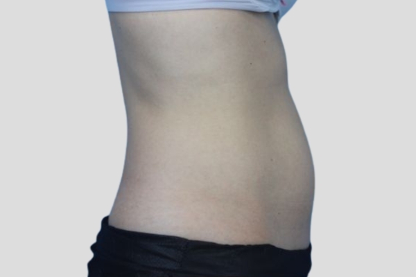 Before treatment: Before and After CoolSculpting - Female Lower Abdomen Belly Pooch - Milwaukee,WI