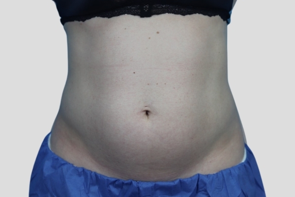 Before treatment: Before and After CoolSculpting - Belly Pooch Female Abdomen - Brookfield, WI