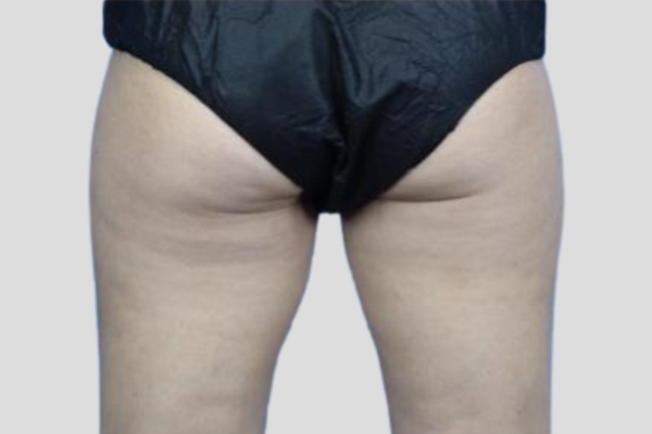 Before treatment: Before and After CoolSculpting - Inner Thighs - Brookfield, WI