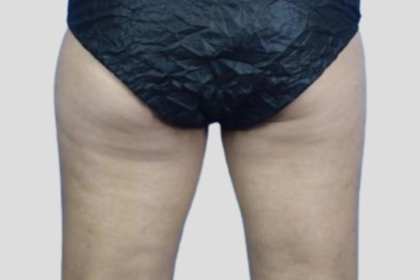 After treatment: Before and After CoolSculpting - Inner Thighs - Brookfield, WI