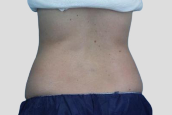 After treatment: Before and After CoolSculpting - Love Handle Fat & Back Fat - Brookfield, WI