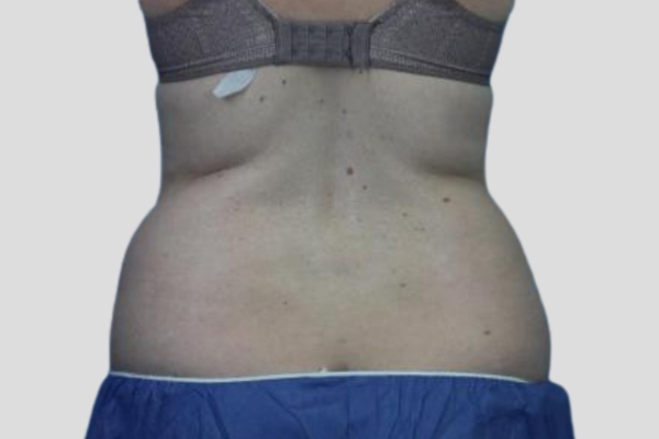 Before treatment: Before and After CoolSculpting - Love Handle Fat & Back Fat - Brookfield, WI