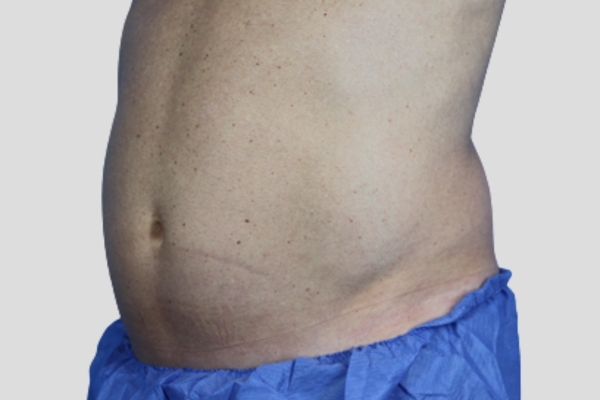 After treatment: Before and After CoolSculpting - Male Abdomen Stomach Fat Beer Belly - Brookfield, WI