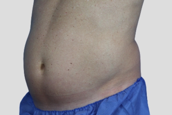 Before treatment: Before and After CoolSculpting - Male Abdomen Stomach Fat Beer Belly - Brookfield, WI