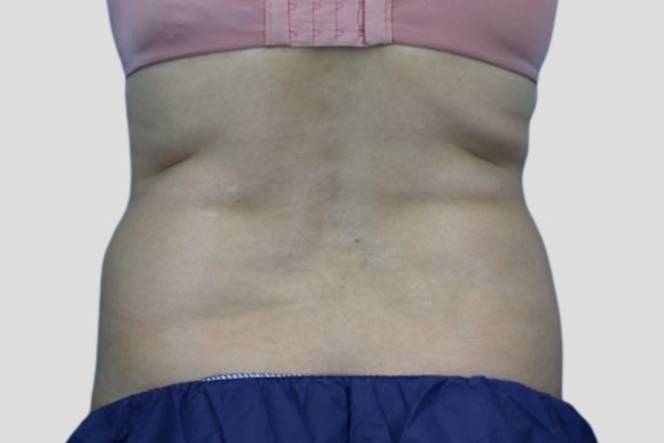 After treatment: Before and After CoolSculpting - Sides Flanks - Brookfield, WI