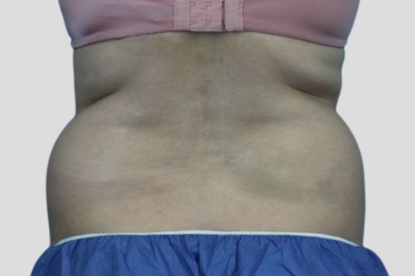 Before treatment: Before and After CoolSculpting - Sides Flanks - Brookfield, WI
