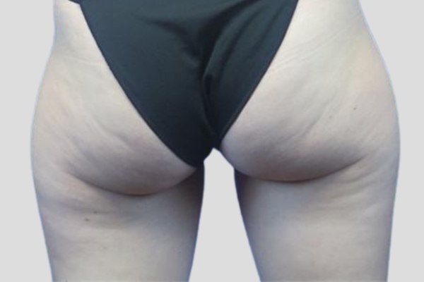 Before treatment: Before and After CoolSculpting - Subgluteal Fat "Banana Roll" - Brookfield, WI