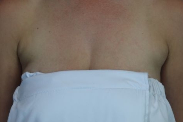 Before treatment: Before and After CoolSculpting - Underarm Armpit Fat - Brookfield, WI