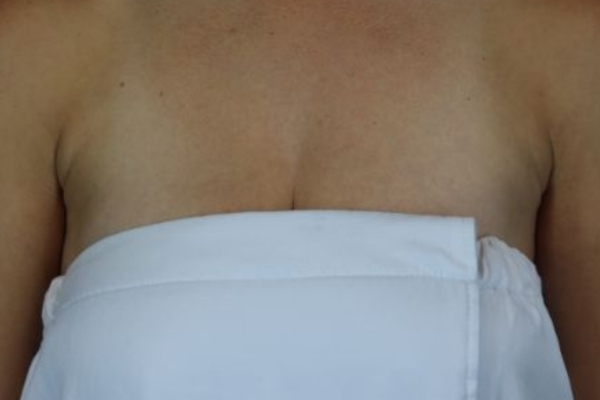 After treatment: Before and After CoolSculpting - Underarm Armpit Fat - Brookfield, WI