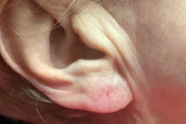 After treatment: Before and After Dermal Filler - Juvederm - Earlobe - Brookfield, WI
