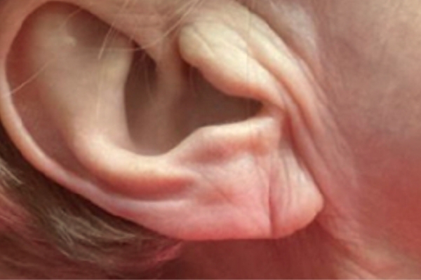 Before treatment: Before and After Dermal Filler - Juvederm - Earlobe - Brookfield, WI