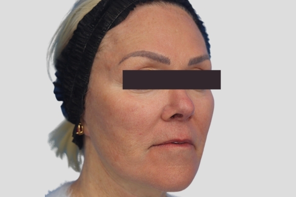 After treatment: Before and After Dermal Filler - Juvederm - Full Face - Waukesha, WI