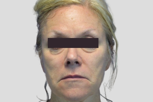 Before treatment: Before and After Dermal Filler - Juvederm - Full Face - Brookfield, WI