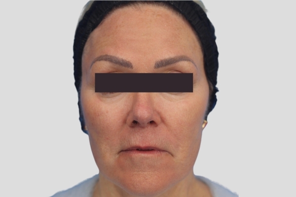 After treatment: Before and After Dermal Filler - Juvederm - Full Face - Brookfield, WI