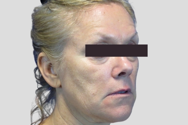 Before treatment: Before and After Dermal Filler - Juvederm - Full Face - Waukesha, WI