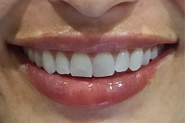 After treatment: Before and After Dermal Filler - Juvederm - Lips - Wauwatosa, WI