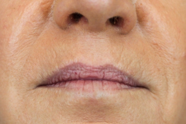 Before treatment: Before and After Dermal Filler - Lips - Juvederm -  Milwaukee WI