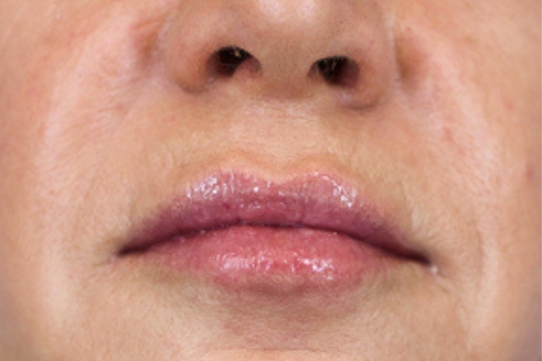 After treatment: Before and After Dermal Filler - Lips - Juvederm -  Milwaukee WI