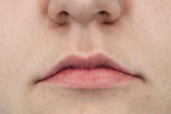 Before treatment: Before and After Dermal Filler - Lips - Juvederm -  Menomonee Falls WI
