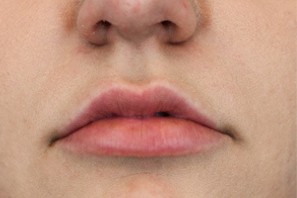After treatment: Before and After Dermal Filler - Lips - Juvederm -  Menomonee Falls WI