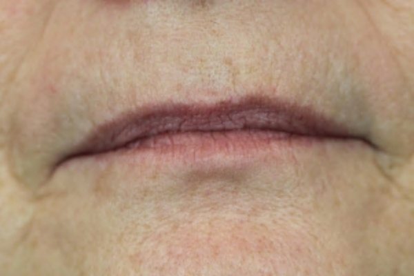 Before treatment: Before and After Dermal Filler - Juvederm - Lips - Greenfield, Wisconsin