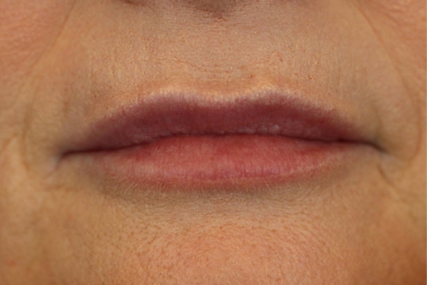 After treatment: Before and After Dermal Filler - Juvederm - Lips - Greenfield, Wisconsin