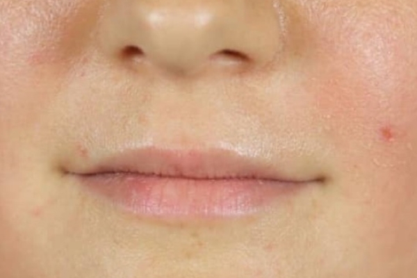 Before treatment: Before and After Dermal Filler - Lips - Juvederm -  Elm Grove WI