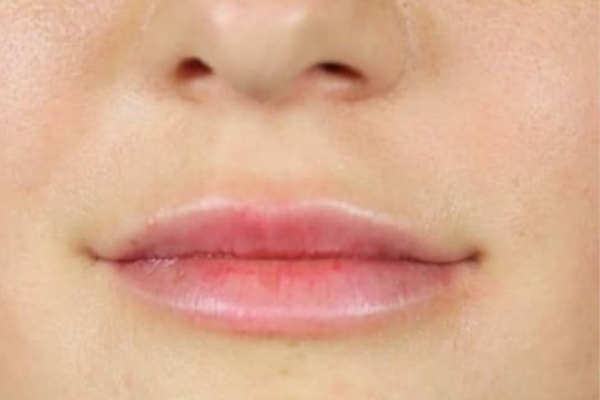 After treatment: Before and After Dermal Filler - Lips - Juvederm -  Elm Grove WI