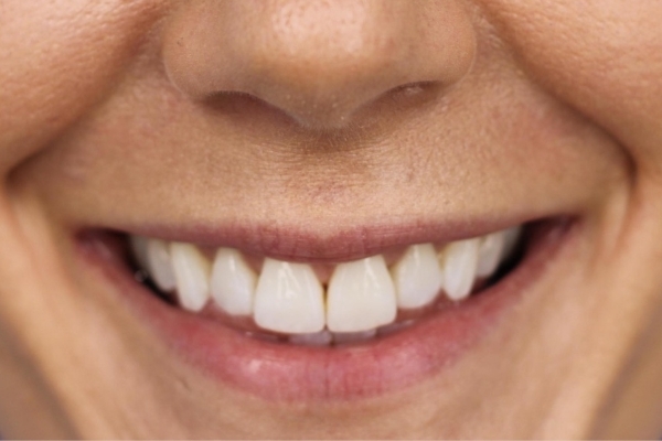 Before treatment: Before and After Dermal Filler - Lips - Juvederm -  Delafield WI