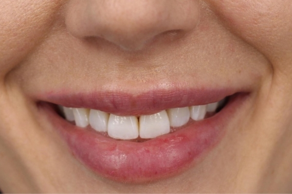 After treatment: Before and After Dermal Filler - Lips - Juvederm -  Delafield WI