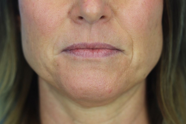 Before treatment: Before and After Dermal Filler - Lips - Juvederm -  Waukesha WI