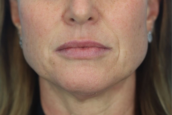After treatment: Before and After Dermal Filler - Lips - Juvederm -  Waukesha WI