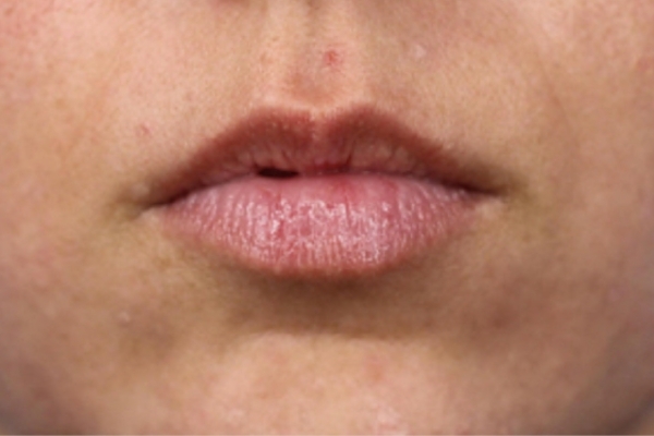 Before treatment: Before and After Dermal Filler - Juvederm - Lips - Pewaukee, WI