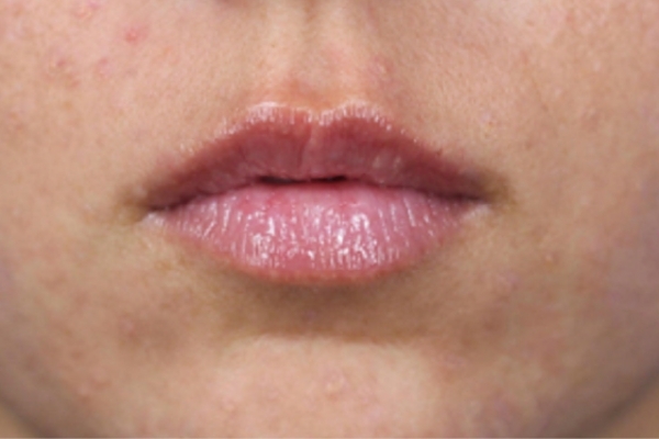 After treatment: Before and After Dermal Filler - Juvederm - Lips - Pewaukee, WI