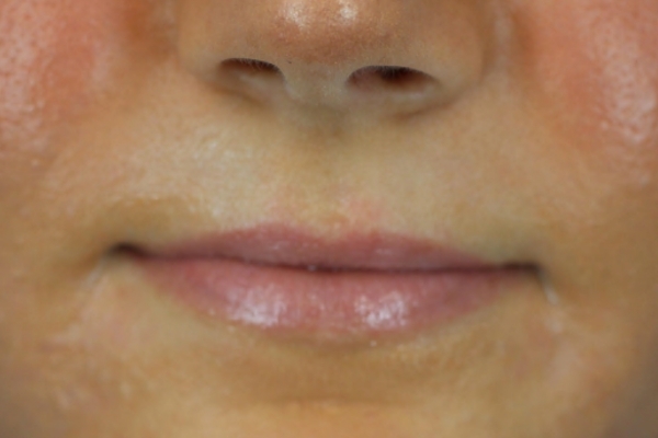 Before treatment: Before and After Dermal Filler - Juvederm - Lips - Oconomowoc, Wisconsin
