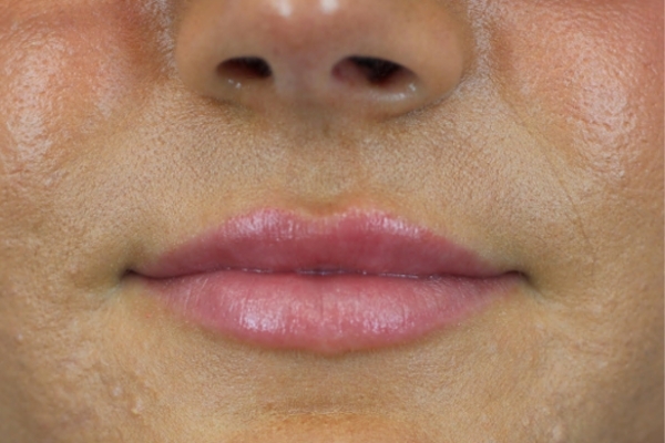 After treatment: Before and After Dermal Filler - Juvederm - Lips - Oconomowoc, Wisconsin