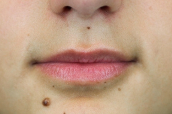 Before treatment: Before and After Dermal Filler - Lips - Juvederm -  Mukwonago WI