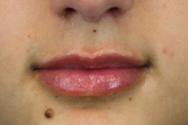 After treatment: Before and After Dermal Filler - Lips - Juvederm -  Mukwonago WI