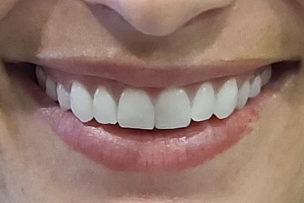 Before treatment: Before and After Dermal Filler - Juvederm - Lips - Wauwatosa, WI