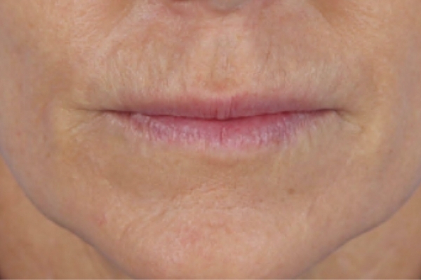 After treatment: Before and After Dermal Filler - Juvederm - Perioral - Brookfield, WI