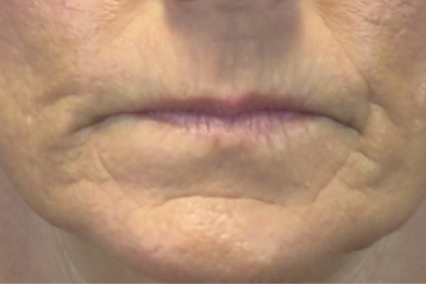 Before treatment: Before and After Dermal Filler - Juvederm - Perioral - Brookfield, WI