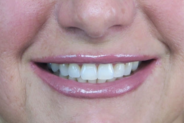 After treatment: Before and After Dermal Filler - Lips - Juvederm Ultra -  Brookfield WI