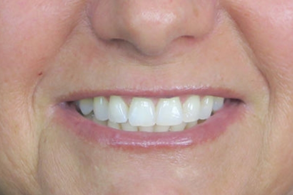 Before treatment: Before and After Dermal Filler - Lips - Juvederm Ultra -  Brookfield WI