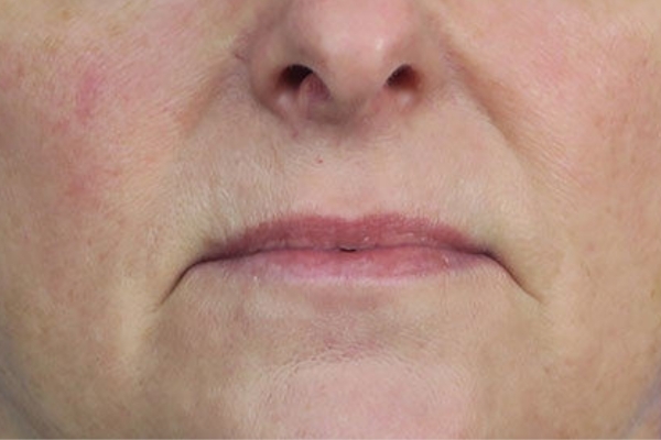 Before treatment: Before and After Dermal Filler - Marionette Lines - Juvederm Vollure -  Brookfield WI