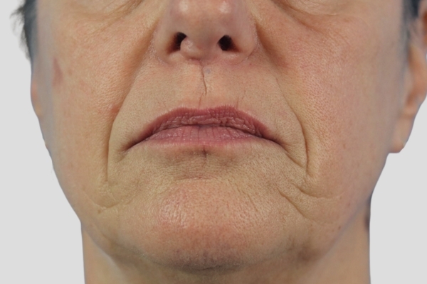 Before treatment: Before and After Dermal Filler - Juvederm Voluma - Lower Face - Brookfield, Wisconsin