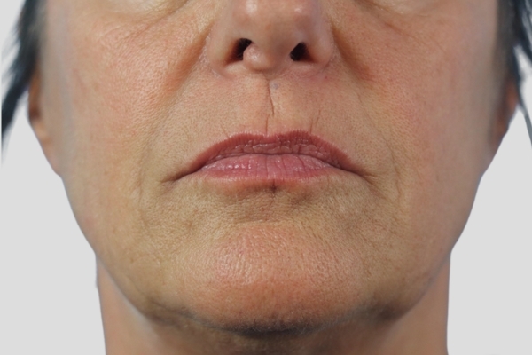 After treatment: Before and After Dermal Filler - Juvederm Voluma - Lower Face - Brookfield, Wisconsin