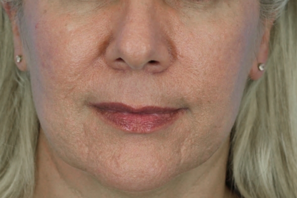 Before treatment: Before and After Dermal Filler - Juvederm Voluma - Cheeks, Chin, & Midface - Brookfield, WI
