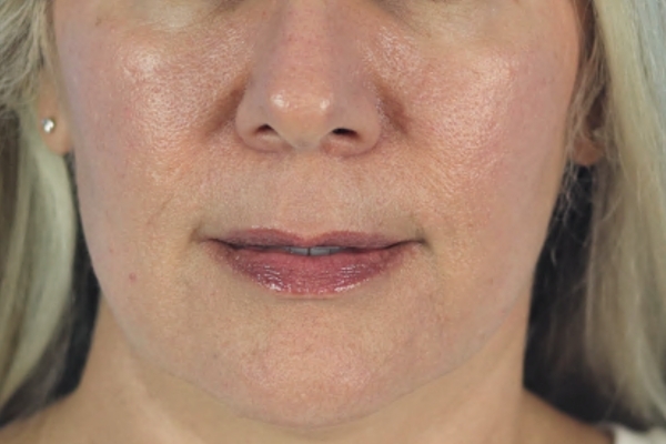 After treatment: Before and After Dermal Filler - Juvederm Voluma - Cheeks, Chin, & Midface - Brookfield, WI