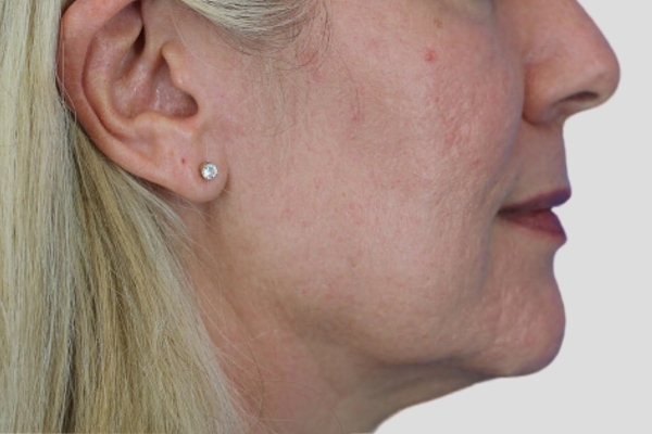 Before treatment: Before and After Dermal Filler - Juvederm Voluma - Cheeks & Midface - Waukesha, WI