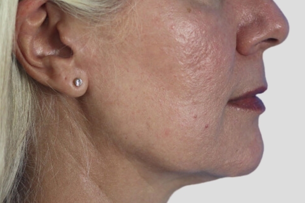 After treatment: Before and After Dermal Filler - Juvederm Voluma - Cheeks & Midface - Waukesha, WI